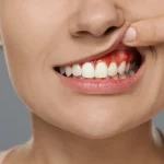 Woman pointing to inflamed red gums showing early signs of gum disease